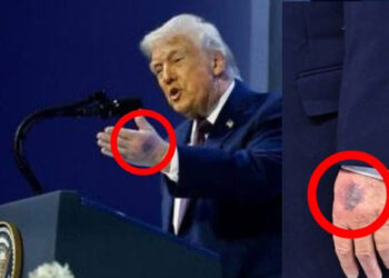 Donald Trump hand injury seen during Davos event