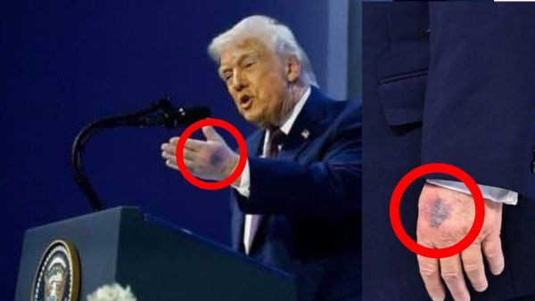 Donald Trump hand injury seen during Davos event